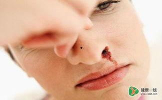 成人鼻子出血视频播放,视频解析背后的真相